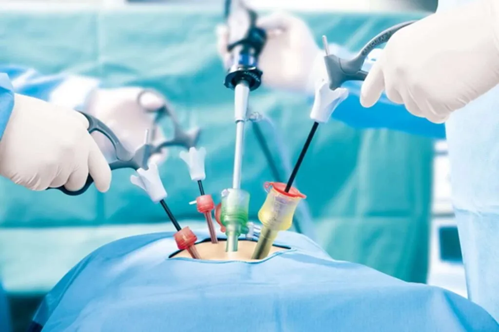 Laparoscopic Hernia Repair