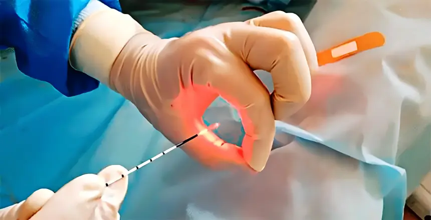 Laser Fistula & Fissure Surgery