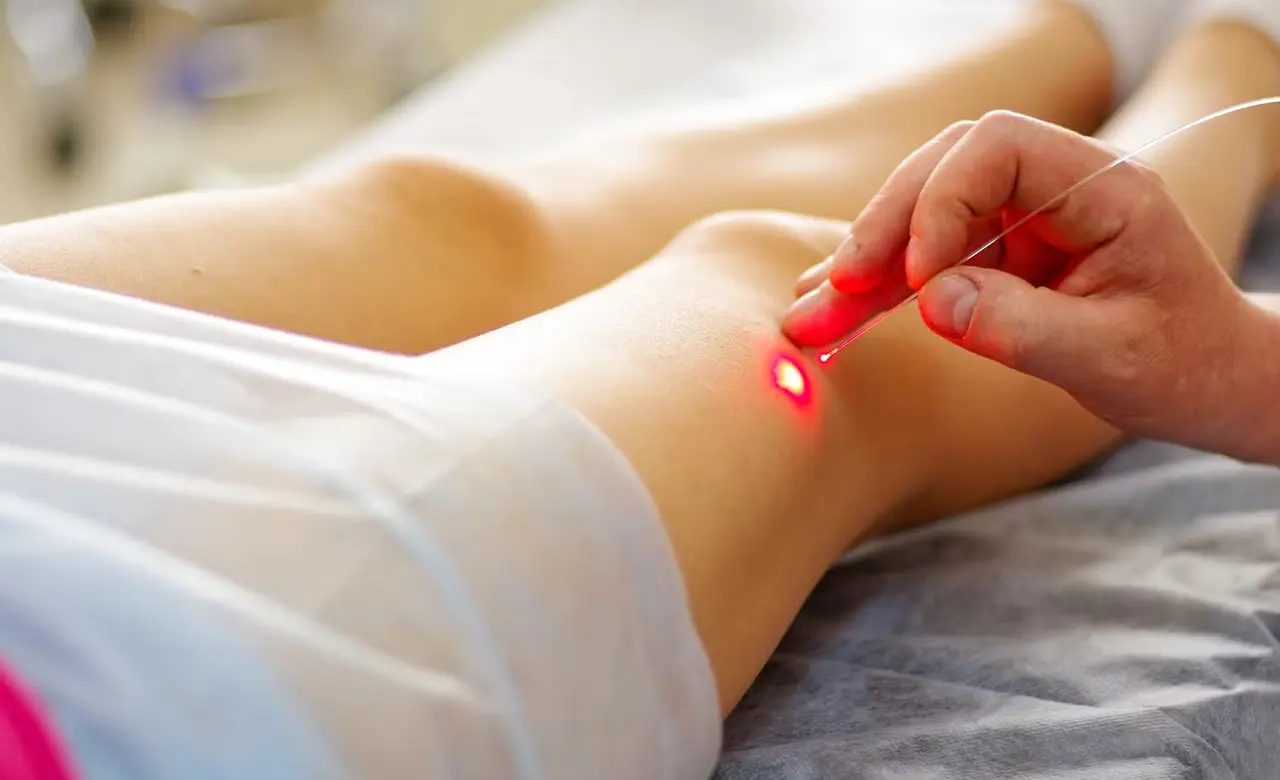 Varicose Vein Laser Treatment